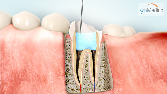 Entfernung der entzündeten Zahnnerven